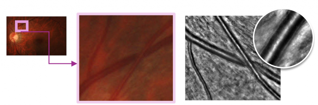 Comparison of image of eye using Conventional color fundus camera vs RTX1